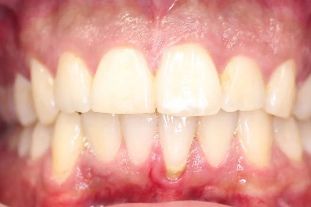 After treatment