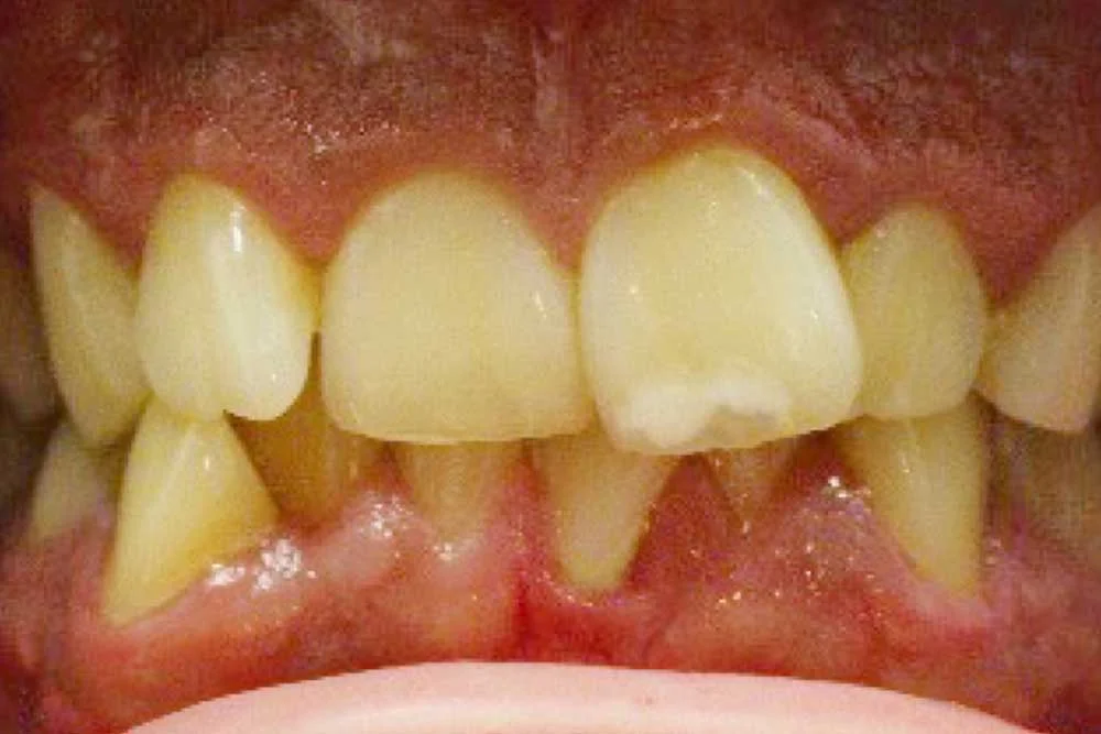 Before treatment