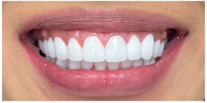 After treatment