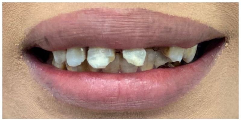 Before treatment
