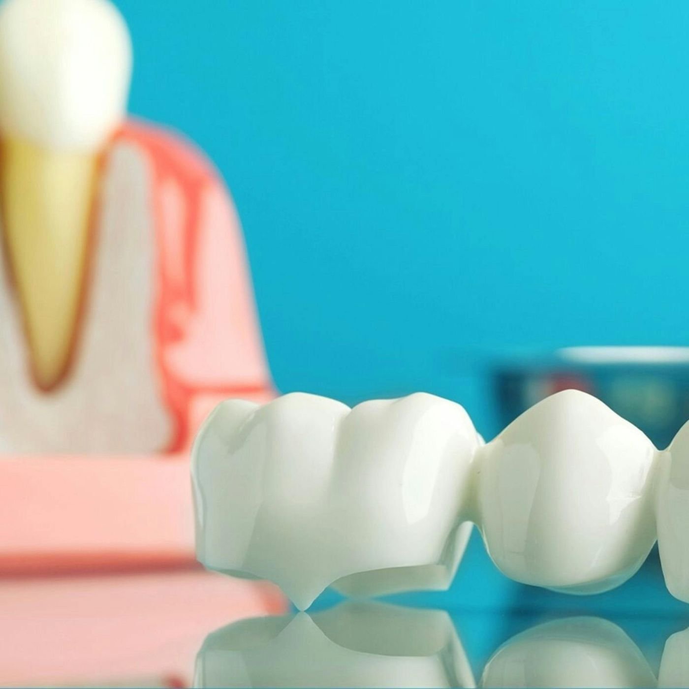Dental crown on a model