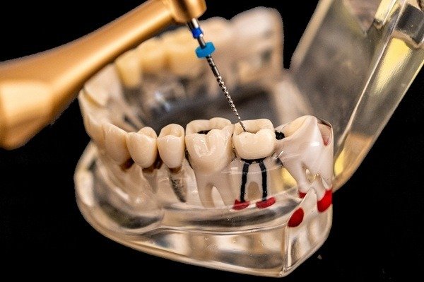 Root Canals — anatomical illustration