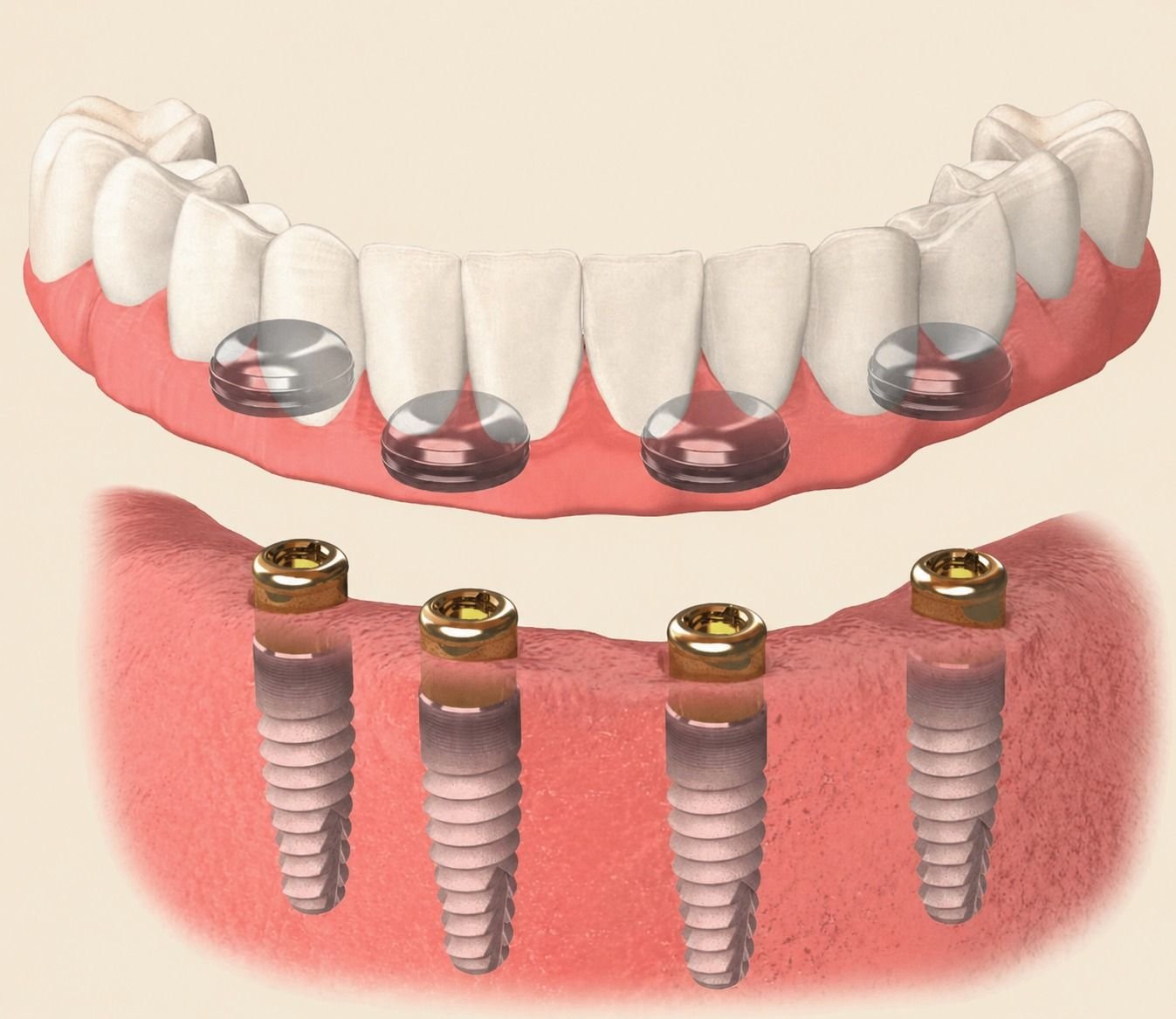 Implant Overdentures in Fort Worth, TX — anatomical illustration