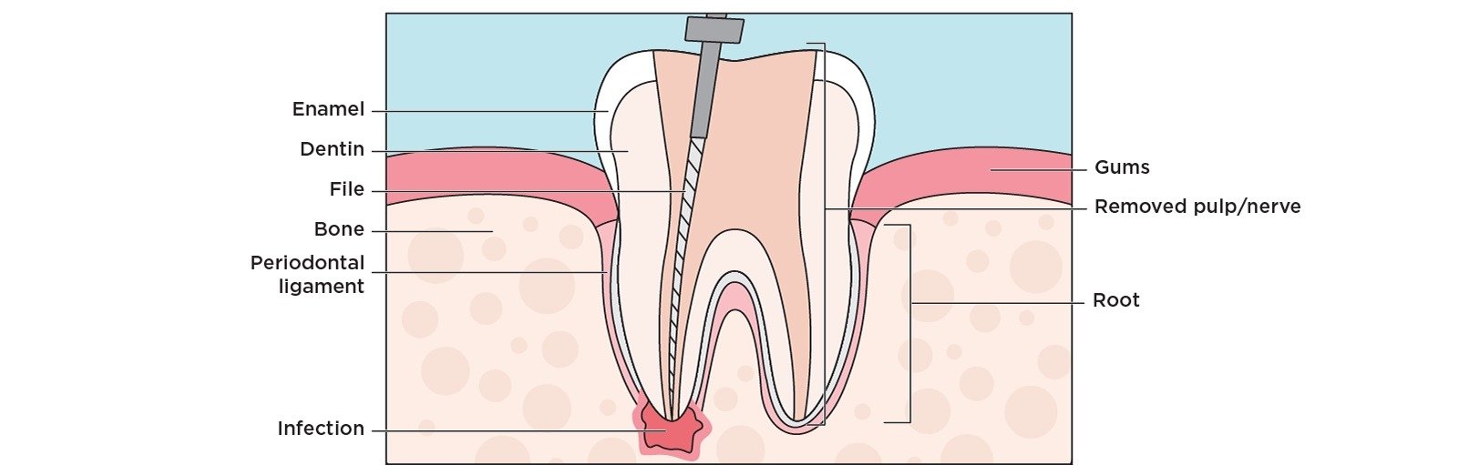 Root Canals — Northwest Family Dental Fort Worth TX