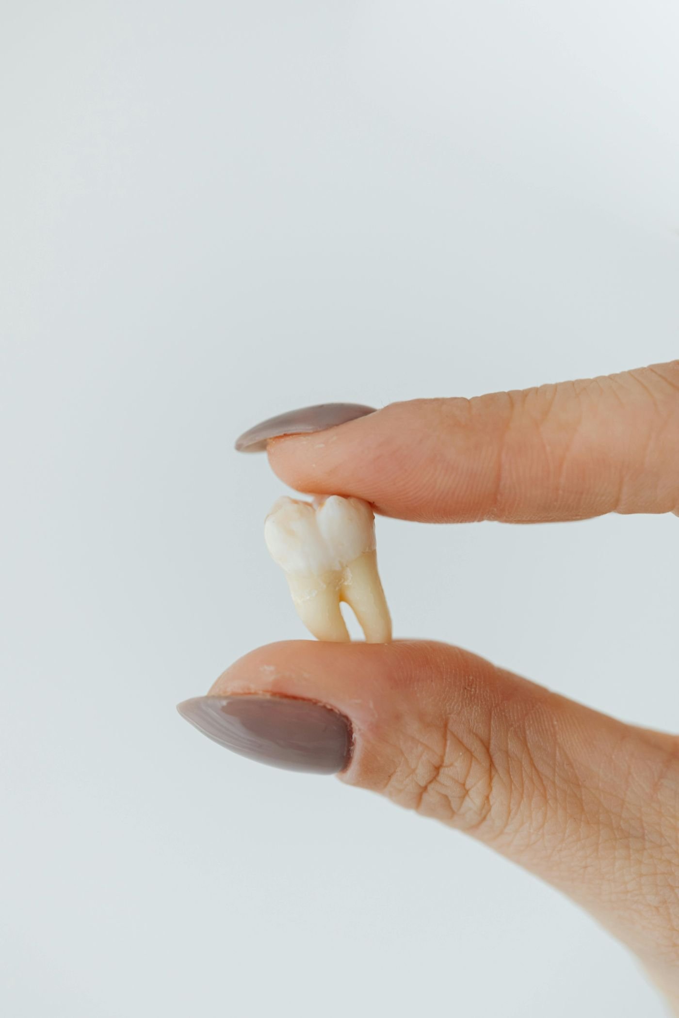 Wisdom Teeth Extractions — anatomical illustration